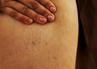 Varicose veins on female legs in the area of the knee and calves. Sipder veins thigh, close-up