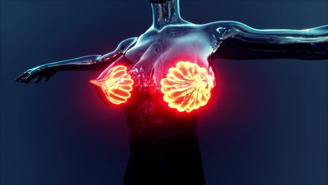 Female breast with cancer focus of inflammation
