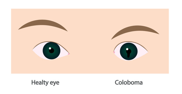 Coloboma illustration. Eye disease representation. 