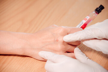 A hand of a doctor points to the origin of the monkeypox.