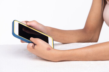 Disabled person hand without fingers since childhood brith, using internet phone to communicate text and chat. Woman use short fingers to touch screen as normal people, white background isolated