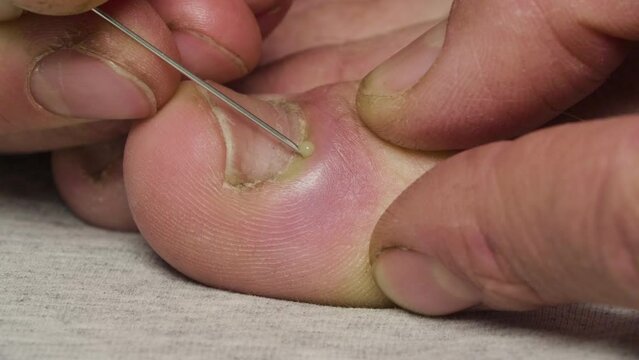 Man pierces the skin with a needle and squeezes pus from a callus near his big toe nail