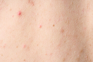 Skin with acne, with red spots. Health problem, skin diseases. Close up Allergy rash. Dermatitis...