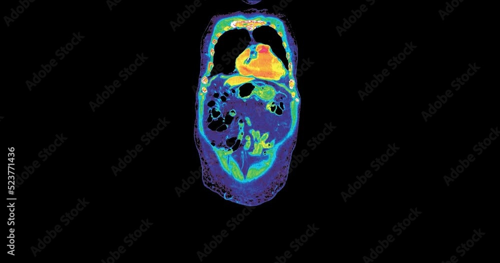 Wall mural CT Scan of chest and abdomen in colorful mode or Pet scan. 