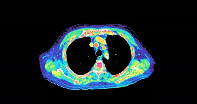 CT Scan of chest and abdomen in colorful mode or Pet scan. 