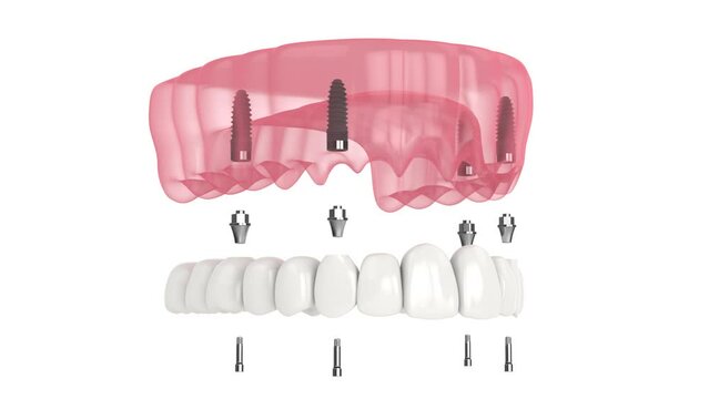 Dental prosthesis all-on-4 system supported by implants