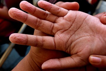 Wrinkles on the palms from soaking in water for too long