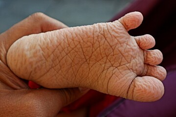 Wrinkles on the soles of the feet from soaking in the water for too long
