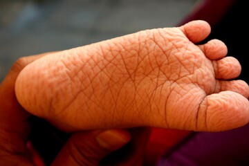 Wrinkles on the soles of the feet from soaking in the water for too long