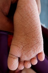 Wrinkles on the soles of the feet from soaking in the water for too long