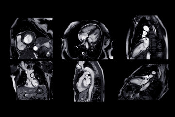 Collection of MRI heart or Cardiac MRI