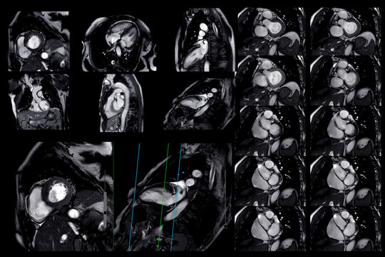 Collection of MRI heart or Cardiac MRI