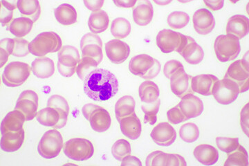 Picture of white blood cell, red blood cell and platelet in blood film, analyze by microscope,...