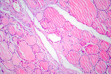 Fibrous thyroiditis, light micrograph