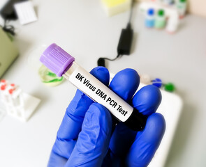 Molecular biologist holding blood sample for Bk virus DNA PCR test.