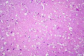 Histopathology of Japanese encephalitis, light micrograph