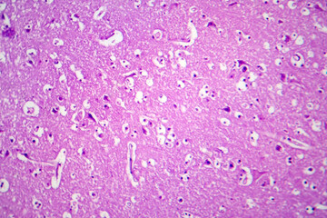 Histopathology of Japanese encephalitis, light micrograph