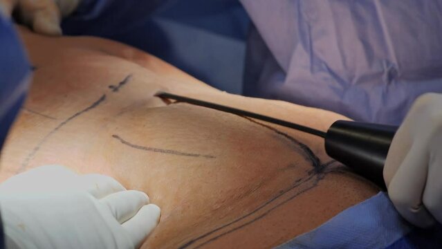 Liposuction corrective plastic surgery for liposuction of fat deposits in the abdomen. Beauty and success, crunchy body.
