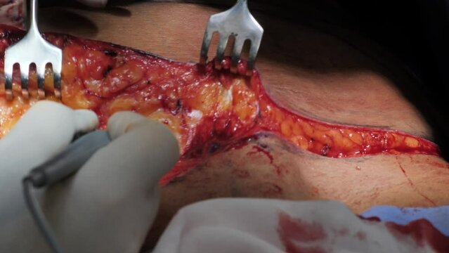 Surgical operation abdominoplasty. Close-up of the patient on the operating table, surgical removal of fat tissue from the abdomen.