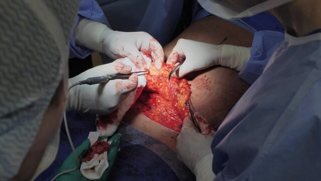 Surgical operation abdominoplasty. Close-up of the patient on the operating table, surgical removal of fat tissue from the abdomen.