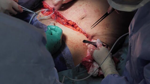 Surgical operation abdominoplasty. Close-up of the patient on the operating table, surgical removal of fat tissue from the abdomen.