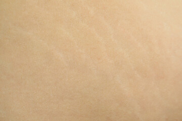 Texture of human skin with birthmark and stretch marks, closeup view