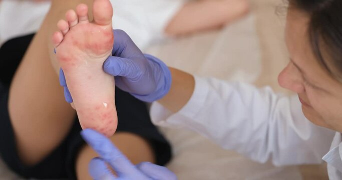 Doctor applied gel to feet of child with red allergic spots and viral rashes