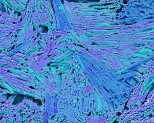 Uric acid crystals in gout, SEM
