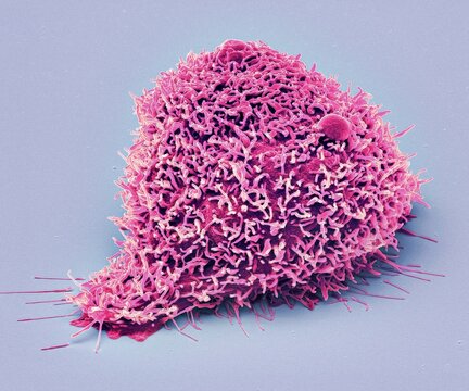 Kidney Cancer Cell, SEM