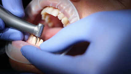 Dentist prepares woman teeth for the installation of ceramic veneers and crowns using drill