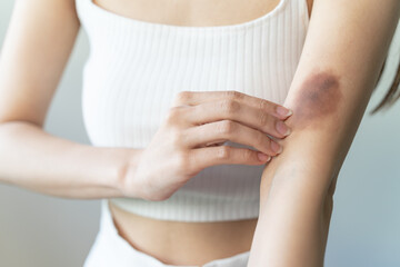 woman get injured and have bruised on her arm. - obrazy, fototapety, plakaty