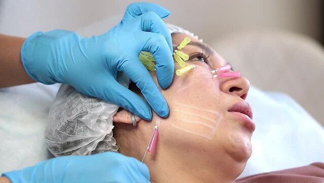 Thread lifting is a cosmetological procedure for face rejuvenation. The beautician implants cosmetic threads under the skin to relieve facial ptosis.