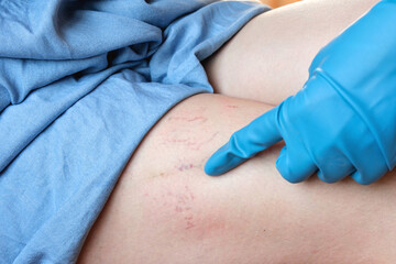 Phlebologist examines a patient with varicose veins on his leg. Leg pain. Phlebology. Venous...