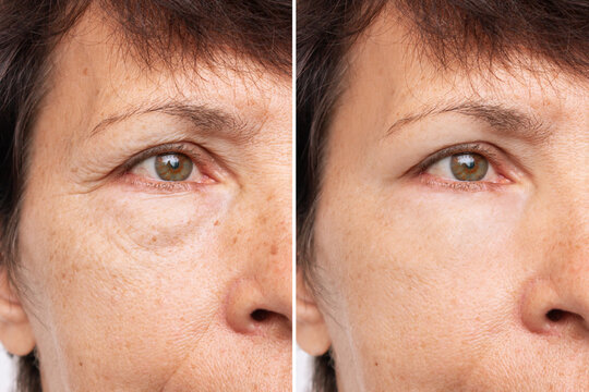 Two shots of an elderly caucasian woman's face with puffiness under her eyes and wrinkles before and after treatment. Age-related skin changes, fatigue. Result of blepharoplasty plastic surgery