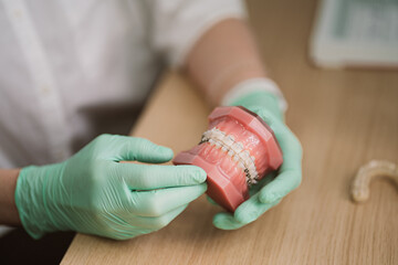 Human jaw or teeth orthodontic dental model with dental braces implants in the hands of an...
