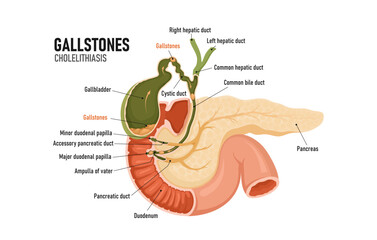 Cholelithiasis. Formations in the gallbladder. Blockage of the bile duct. Pancreas. - obrazy, fototapety, plakaty
