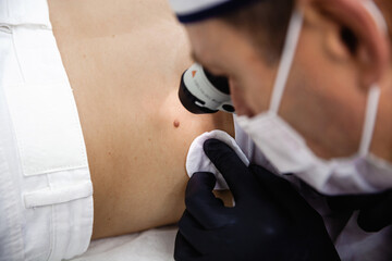 A cosmetologist in a white cap and black gloves examines a mole on the patient's back using a dermatoscope - Powered by Adobe