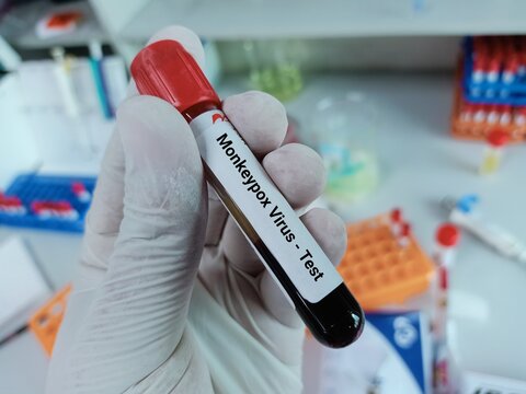 Biochemist of Scientist holds blood sample for Monkeypox virus test. A double stranded DNA virus and member of Poxviridae family. - Powered by Adobe