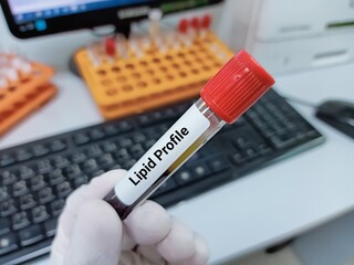 Biochemist of Scientist holds blood sample for Lipid Profile test. Medical test tube in laboratory...
