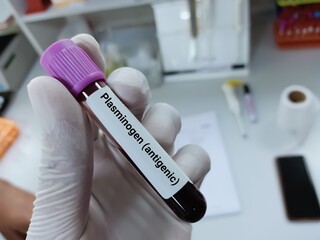 Biochemist of Scientist holds blood sample for  Plasminogen (antigenic) test. Medical test tube in...