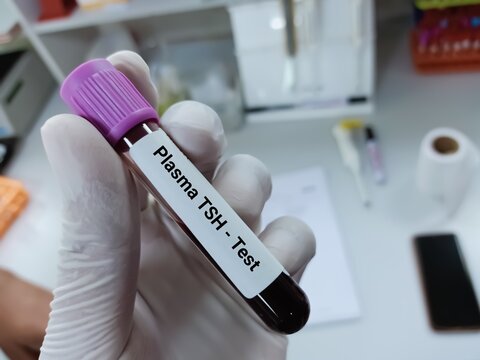 Biochemist of Scientist holds blood sample for plasma TSH test for thyroid disease diagnosis. Medical test tube in laboratory background.