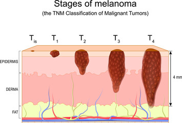stages of melanoma. The TNM Classification of Malignant Tumors