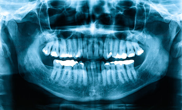 Panoramic Dental X-Ray, Orthopantomogram single panoramic image of the oral cavity with teeth.