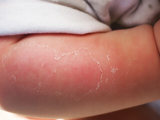 Red hand kid baby skin close up sunburn from sun. peeling of the skin on the arm of a child