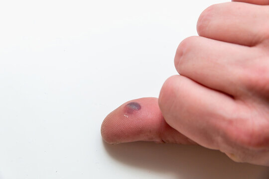 Blood blister under the thumb skin. Caucasian young man finger on white background.
