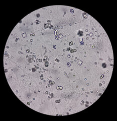 Microscopic image showing Calcium oxalate (monohydrate and dihydrate) crystals from urine sediment,...