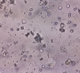 Microscopic image showing Calcium oxalate (monohydrate and dihydrate) crystals from urine sediment,...
