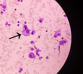 Microscopic image of bone marrow. Plasma cell dyscrasia or Multiple myeloma. A type of bone marrow...