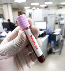 Scientist holding blood sample for Meningitis or Encephalitis PCR test to diagnosis of meningococcal disease.