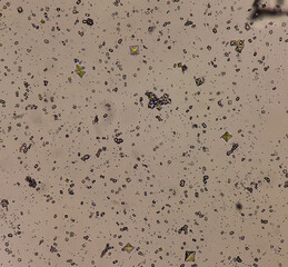 Microscopic image showing Calcium oxalate (monohydrate and dihydrate) crystals from urine sediment, most common cause of kidney stones.